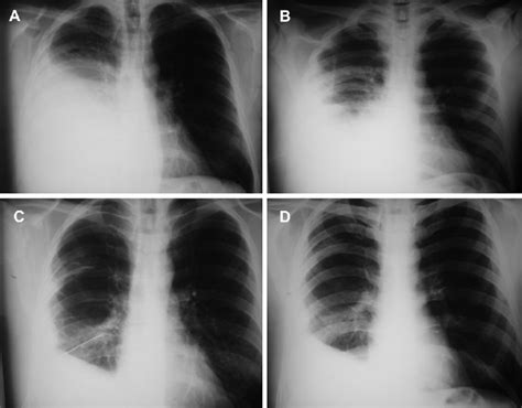 (A) Chest x-ray performed before treatment. (B) Chest x-ray performed ...