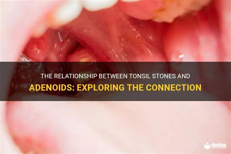 The Relationship Between Tonsil Stones And Adenoids: Exploring The Connection | MedShun