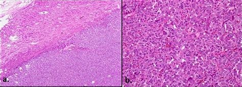 A ×2 Magnification Showing Pheochromocytoma Arising From Medulla In Download Scientific