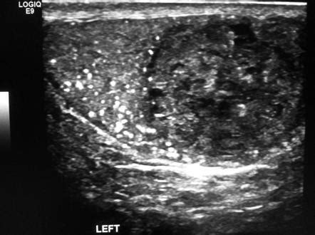 Testicular Teratoma Ultrasound