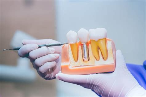 What Is Permanent Teeth Implants Procedure?