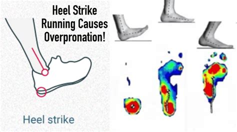 Heel Strike Running Causes Overpronation RUN FOREFOOT