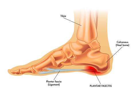 Effectiveness Of Simultaneous Stretching Of The Achilles Tendon