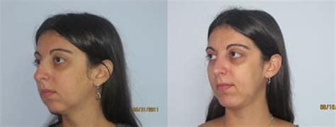 Rhinoplasty Before and After Pictures Fort Lauderdale, Coral Springs, FL