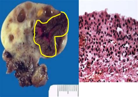 Path Of Ovarian Cysts And Tumors Of Epithelial Origin Flashcards Quizlet