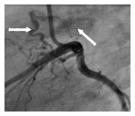 Two Branches Originating From Left Anterior Descending Coronary Artery