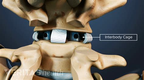 Interbody Cages For Spine Fusion