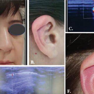 Figure A shows significant inflammation of the nasal bridge, figures B ...