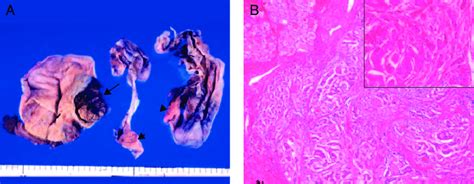 Case Of Sc Tumors A Gross Examination Of The Resected Specimen A