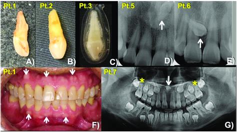 Mesiodens Phenotypes Extracted Mesiodens Of A Patient 1 B Patient