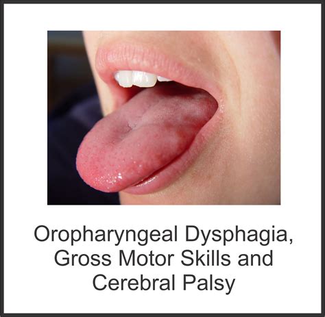 Oropharyngeal Dysphagia, Gross Motor Skills and Cerebral Palsy | Your ...