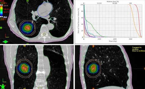 Stereotactic Body Radiation Therapy – Clearwater Radiation Oncology