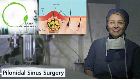 Pilonidal Sinus Surgery Dr Zahra Saadati Laser Surgery