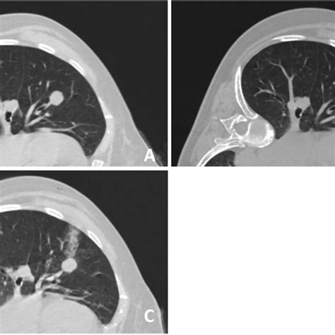 A 63 Year Old Female With A 2 1 Cm Nodule In The Right Middle Lung