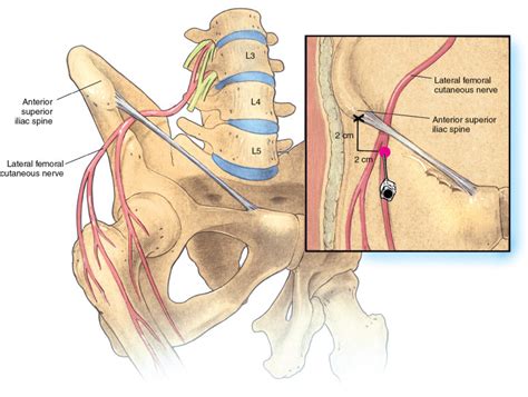 Femoral Nerve Block Landmarks