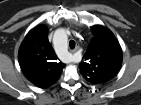 Subclavian Artery Anatomic Review And Imaging Evaluation Of Abnormalities Radiographics