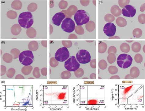 Panels Af Peripheral Blood Smear Showed Numerous Small Atypical