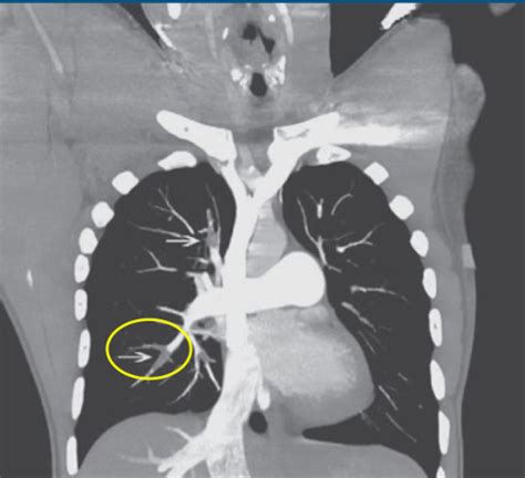 PULM Pulmonary Circulation Disorders Flashcards Quizlet