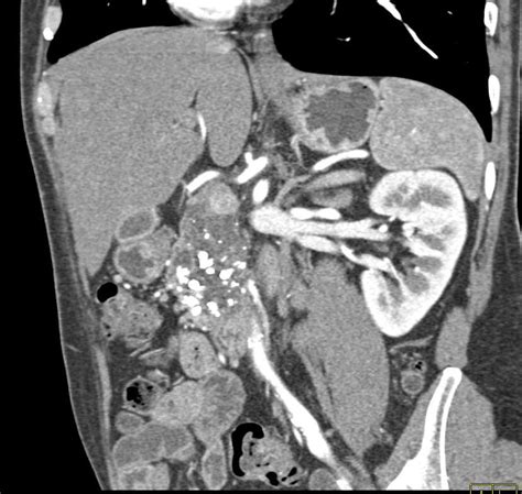 Chronic Pancreatitis With Glandular Calcification And Dilated