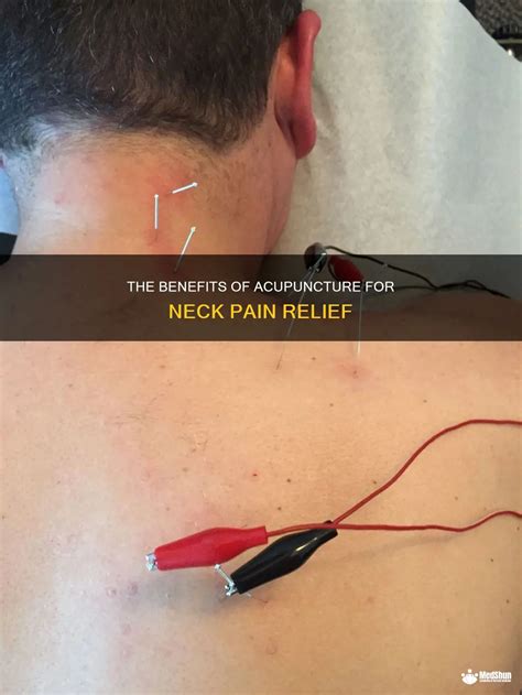 The Benefits Of Acupuncture For Neck Pain Relief Medshun