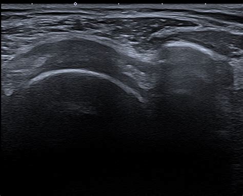 La Capsulitis Adhesiva Popularmente Conocida Como Hombro Congelado Es