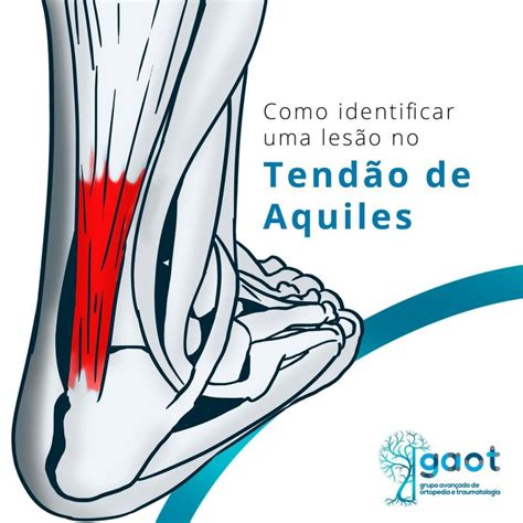 Como identificar uma lesão no Tendão de Aquiles GAOT