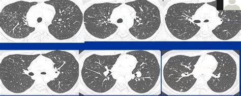 000 Sarcoidosis | Lungs