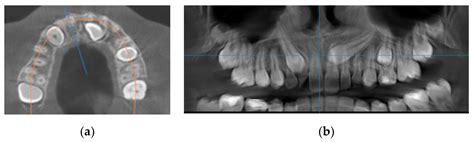 Root Resorptions On Adjacent Teeth Associated With Impacted Maxillary