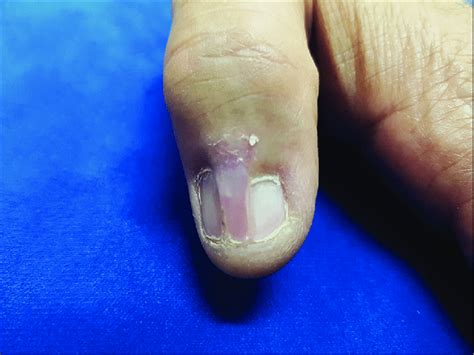 Extension Of The Proximal Nail Fold Over The Nail Plate Creating Split