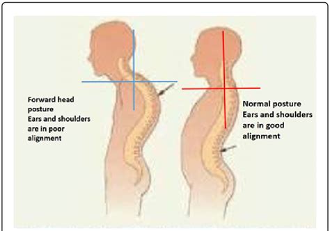 Forward Head Posture Before And After