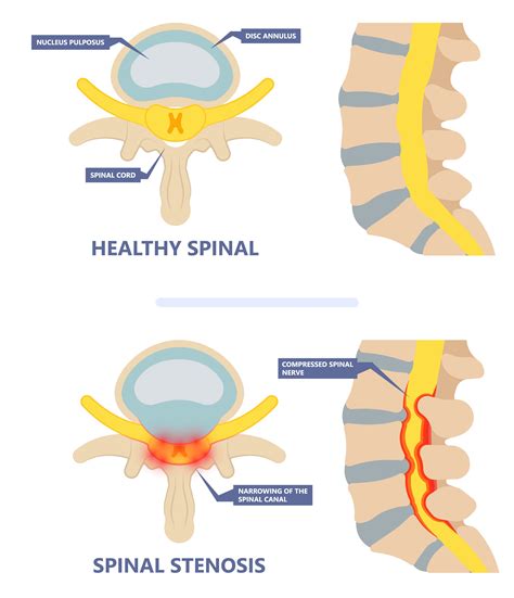 Lumbar Spinal Stenosis Specialists | Pain & Spine Specialists