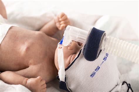 Nasal CPAP In Neonates 2022