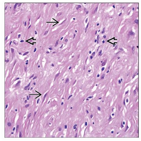 Sclerotic Fibroma Basicmedical Key