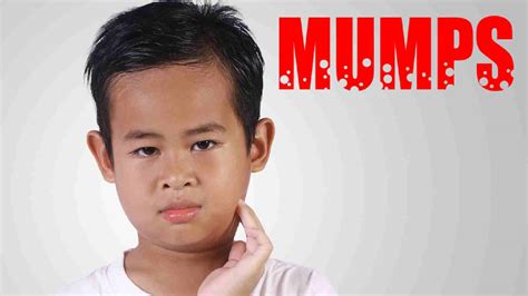 कनफेड़ Mumps लक्षण प्रकार कारण ट्रीटमेंट और प्रिवेंशन हेल्थशॉट्स