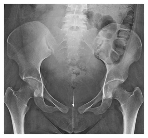 Peripartum Diastasis Of The Symphysis Pubis New England Journal Of Medicine