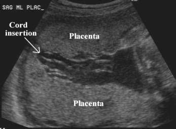 Succenturiate Lobe Placenta Ultrasound