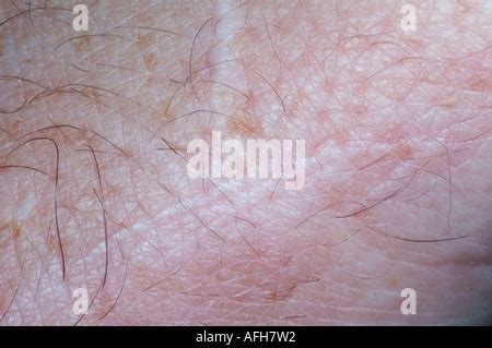 Vitiligo : Koebner phenomenon Stock Photo - Alamy