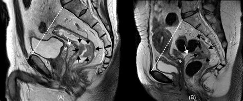 Frontiers Clinical Implication And Management Of Rectal Cancer With Clinically Suspicious