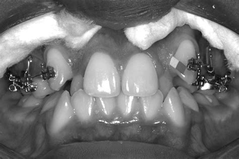 Gingival Crevicular Fluid Gcf Sampling With The Paper Strip In