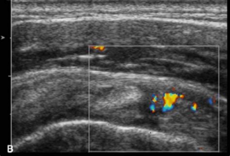 Dr David Samra Sports Medicine Sydney Frozen Shoulder