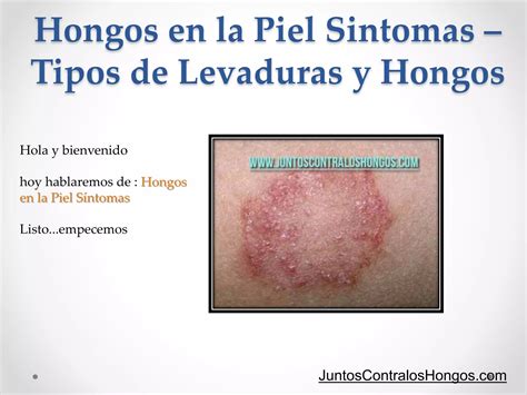 Hongos En La Piel Sintomas Tipos De Levaduras Y Hongos Ppt