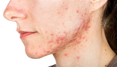 Cystic Acne What Is It Symptoms Causes And Treatment