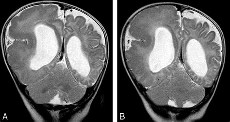 Hemimegalencephaly A Study Of Abnormalities Occurring Outside The