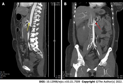 Arcuate Ligament Syndrome