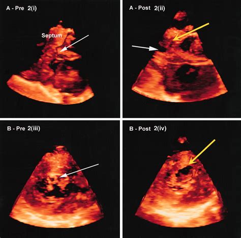 Epicardial Real Time 3 Dimensional Echocardiography During Septal