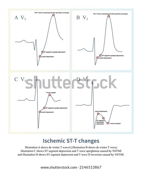 Different Types Acute Myocardial Ischemia Degree Stock Illustration ...