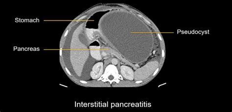 Abdominal CT: necrotizing pancreatitis • LITFL • Radiology Library