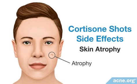 Cortisone Shots for Severe Acne - Nodules and Cysts - Acne.org