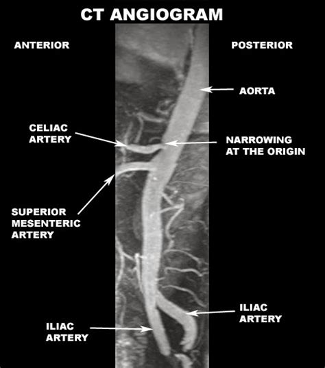 Radiology Anatomy Images : CTA abdominal anatomy