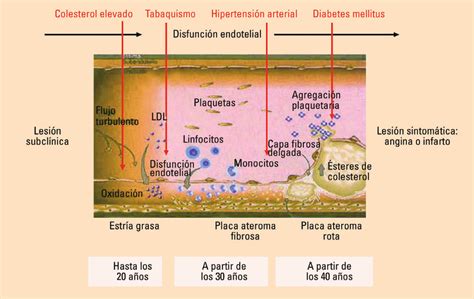 Los factores de riesgo vascular favorecen la evolución de la placa de ...